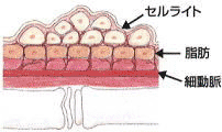 セルライト拡大図