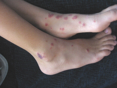 アレルギー性紫斑病ー闘病記 ｍｉｎａｍｉ ｓ クラブ 楽天ブログ