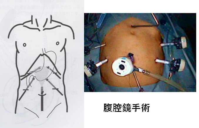 胃ガンの手術ーガイドラインと主に腹腔鏡手術についてー 胃切除者の