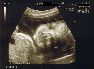妊娠 後期 のエコー写真 うちの双子 弟 ゆきあやママの育児奮闘記 楽天ブログ