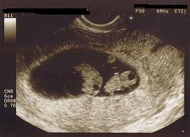 エコー 写真 双子 双子を妊娠！【エコー検査】で分かることを解説！いつ分かる？
