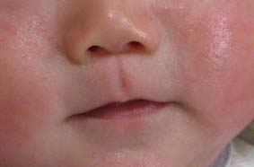息子の湿疹記録 写真付 ｓｉｍｐｌｅ ｌｉｆｅ 1day1click 楽天ブログ