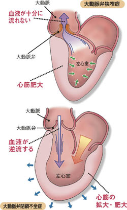 大動脈弁狭窄症と閉鎖不全症の図