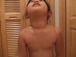 水疱瘡