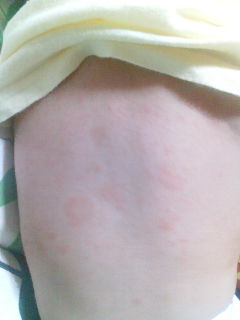 皮疹2