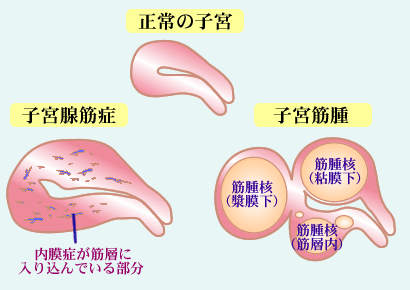 adeno-myoma.gif