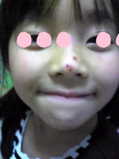 三女怪我その後