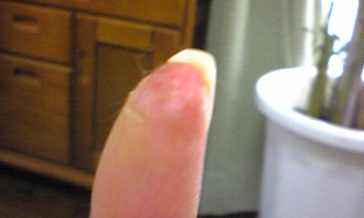 指の怪我その後2