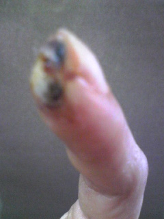 左人差し指怪我抜糸後3