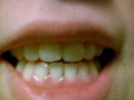 矯正装置を外した後