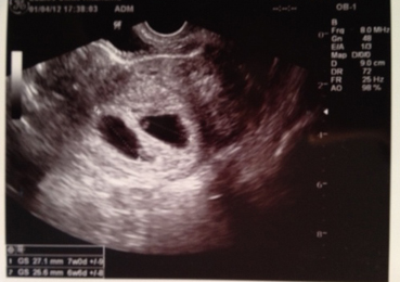 双子妊娠２ヶ月 キャベツ畑とコウノトリ 楽天ブログ