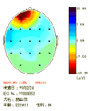 脳波　図　ダテメガネ