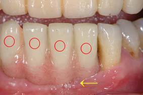 歯肉色・プロビレジンとの比較