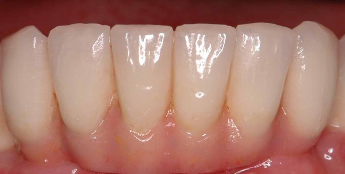 フルセラミック　口腔内