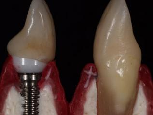 天然歯とインプラントの違い