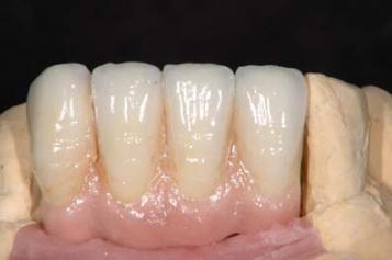 ガミー　その３（参考２）