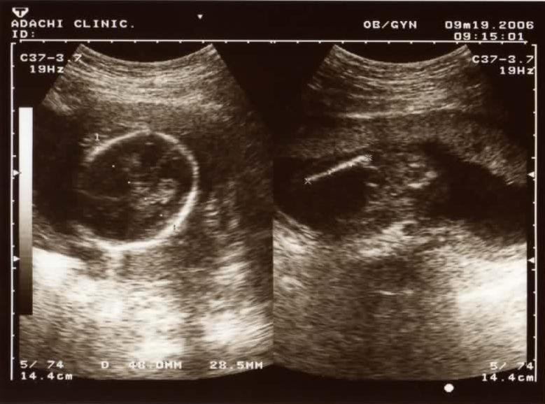 妊娠５ヶ月 ベビーちゃんの成長日記 楽天ブログ