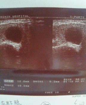 よこ切りエコー画像