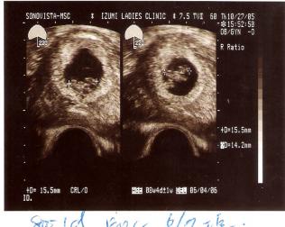 双子妊娠8周