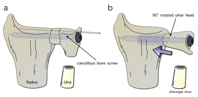 History And Evolution Of The Sauvé-Kapandji Procedure, 47% OFF