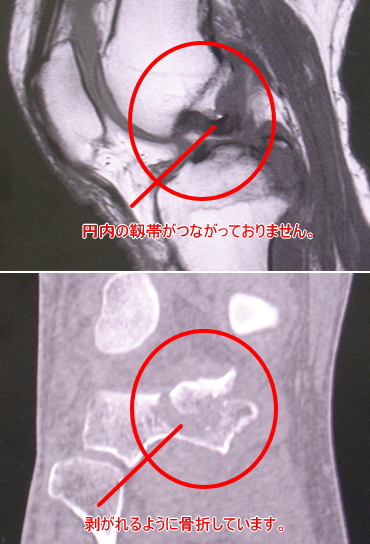 右ひざ骨折