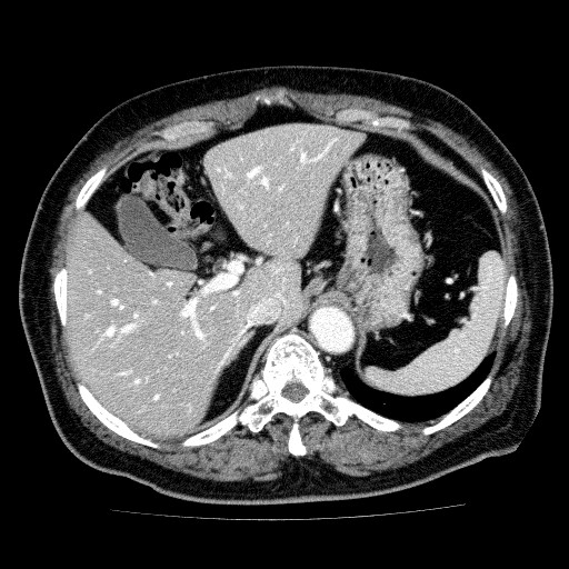 sub-hepatic vein CT.jpg