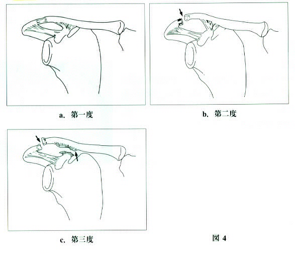 dislocation of the clavicle 分類