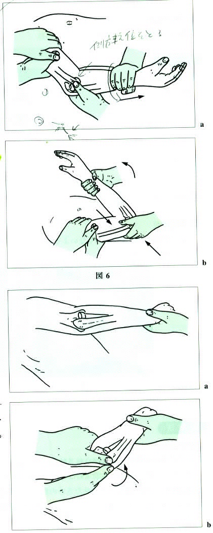 dislocation of the elbow joint