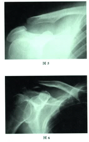 dislocation of the clavicle 鑑別