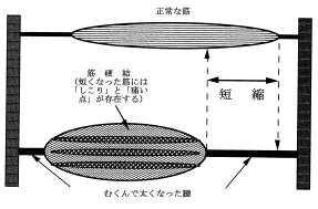 筋硬結というヤマイ 今日も明日もチェアウォーク 楽天ブログ