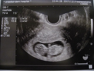 妊娠11週のわが子