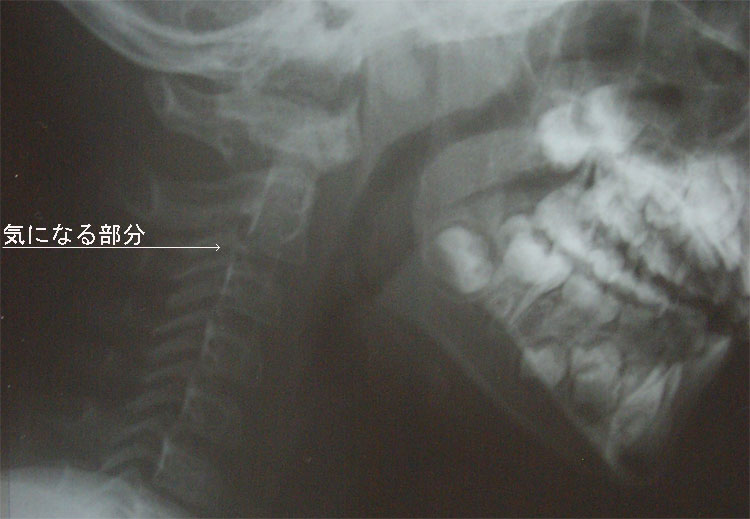 事故当日のレントゲン　　20070411