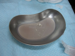 3度目の膿瘍切除&洗浄治療 3