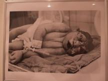 無脳症の子ども　２００１年１２月