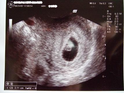 妊娠7週と9週のエコー写真 よだきん坊のブログ 楽天ブログ