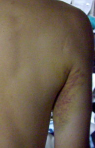 肩、腕の筋肉炎症！