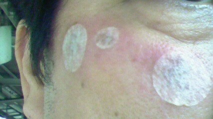 治療直後(右側)テープで保護した状態