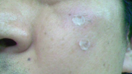 治療直後(左側)テープで保護した状態