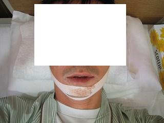 手術後の顔